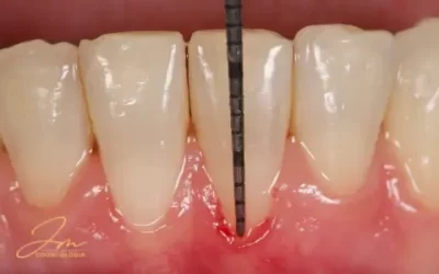 Retração gengival: 1 a cada 3 pessoas tem. Como tratar?