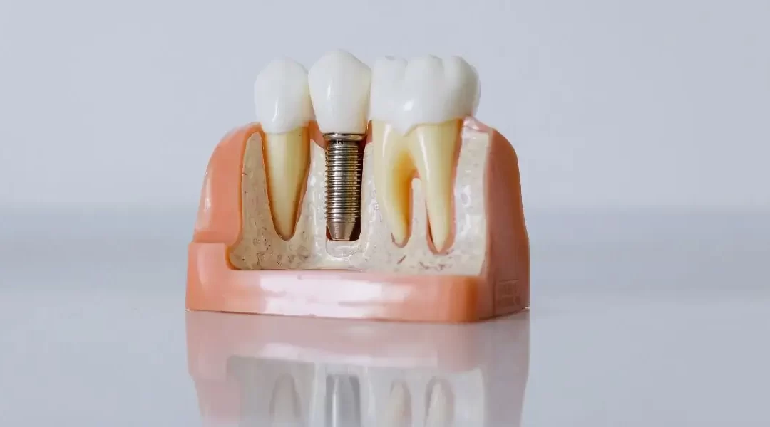 Implante Dentário: O Que é, Benefícios, Preços e Cuidados Essenciais