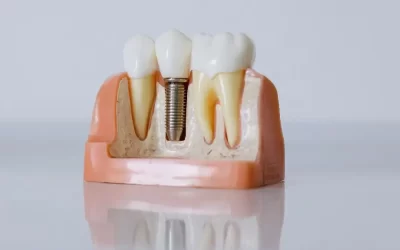 Implante Dentário: O Que é, Benefícios, Preços e Cuidados Essenciais