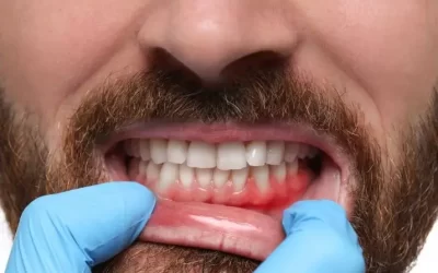 Retração Gengival: causas, sintomas e tratamentos após o uso de aparelho dental