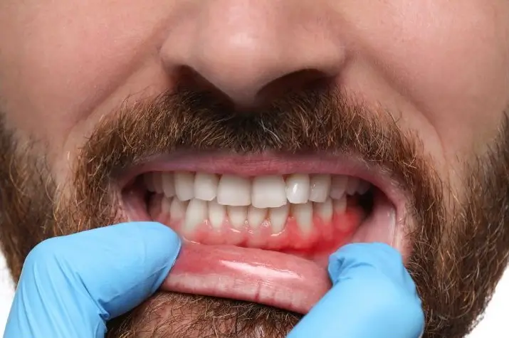 Retração Gengival: causas, sintomas e tratamentos após o uso de aparelho dental